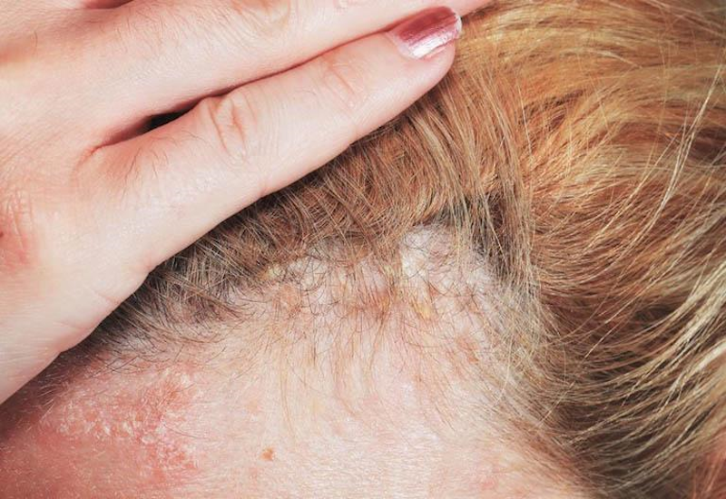 Những nguyên nhân gây ra vảy nấm da đầu là gì?