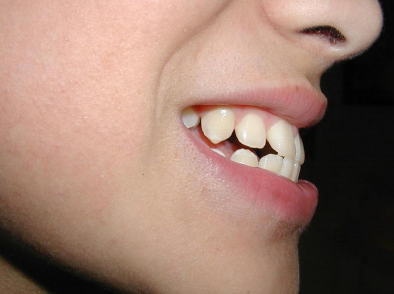 Răng hô nhẹ nhìn nghiêng sẽ thấy hàm trước hơi hướng về trước một góc 20 - 30 độ