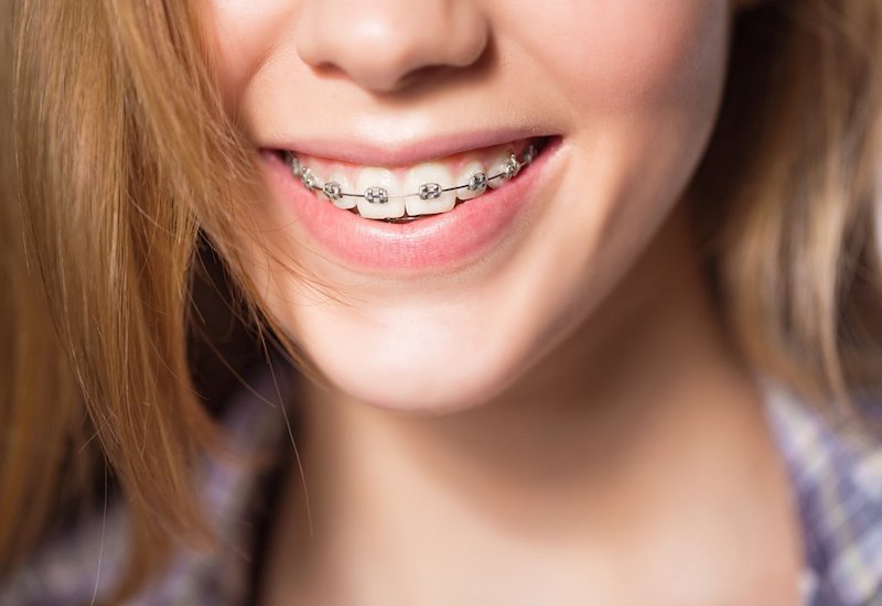 Niềng răng mắc cài kim loại có thể áp dụng đối với trẻ em và người lớn