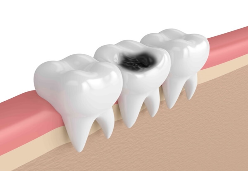 Các bệnh về răng miệng sẽ gây trở ngại cho quá trình niềng răng nên cần điều trị khỏi hẳn
