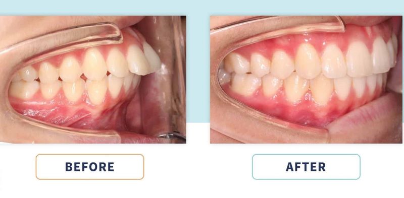 Hình ảnh trước và sau khi niềng răng hô