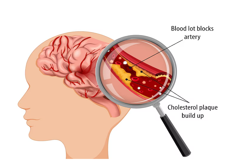 Bị xơ vữa động mạch là một trong những nguyên nhân gây nên thiếu máu não