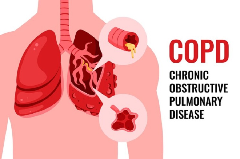 Bệnh phổi tắc nghẽn mạn tính là nguyên nhân gây giảm cung cấp oxy lên não