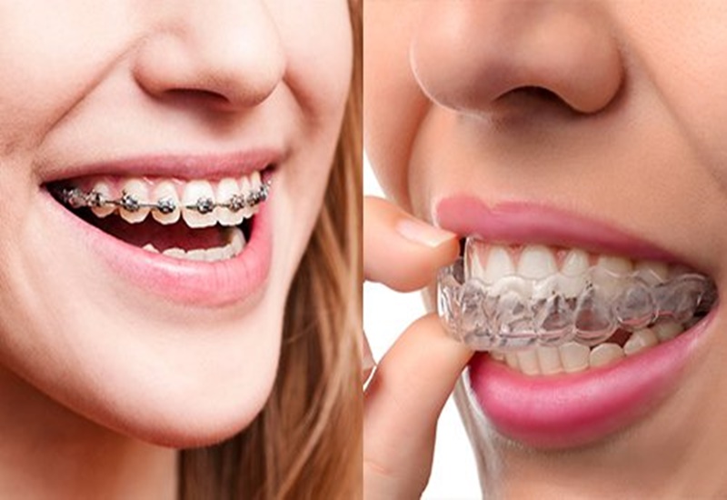 Có nhiều loại niềng răng khác nhau