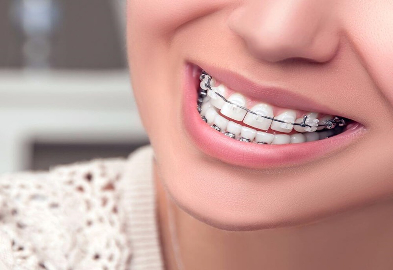 Niềng răng kim loại được sử dụng từ nhiều năm trước