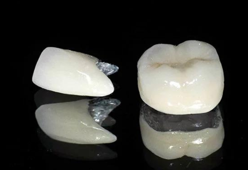Răng sứ kim loại có chi phí và độ bền phù hợp với nhiều người