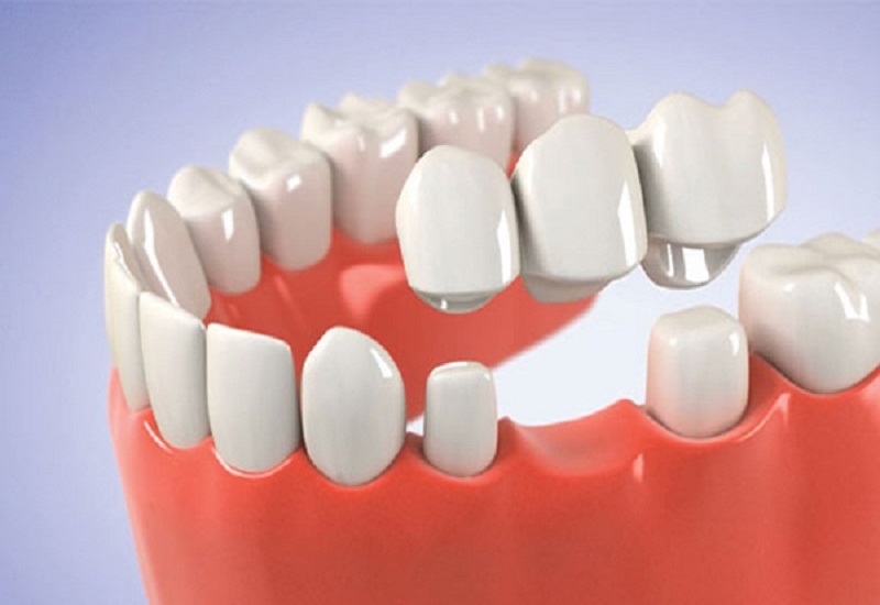 Thẩm mỹ khuôn mặt và chức năng nhai được đảm bảo khi thực hiện trồng răng bắc cầu thay răng mất