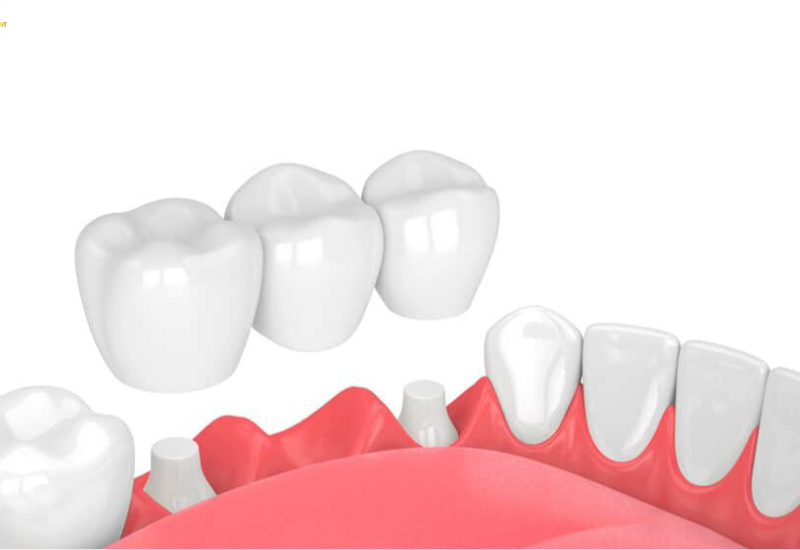 Răng sứ ít bị ố vàng hơn so với răng tự nhiên