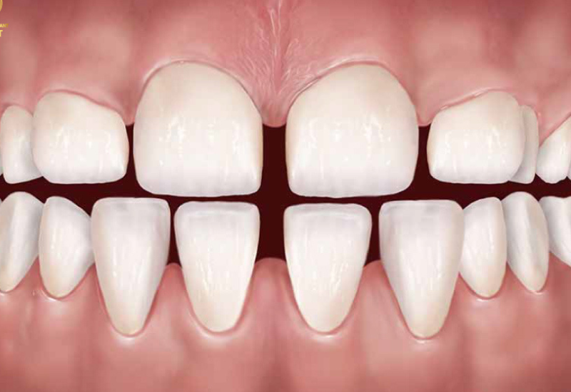 Bọc răng sứ giúp phục hồi màu sắc tự nhiên của răng và tạo nụ cười trắng sáng