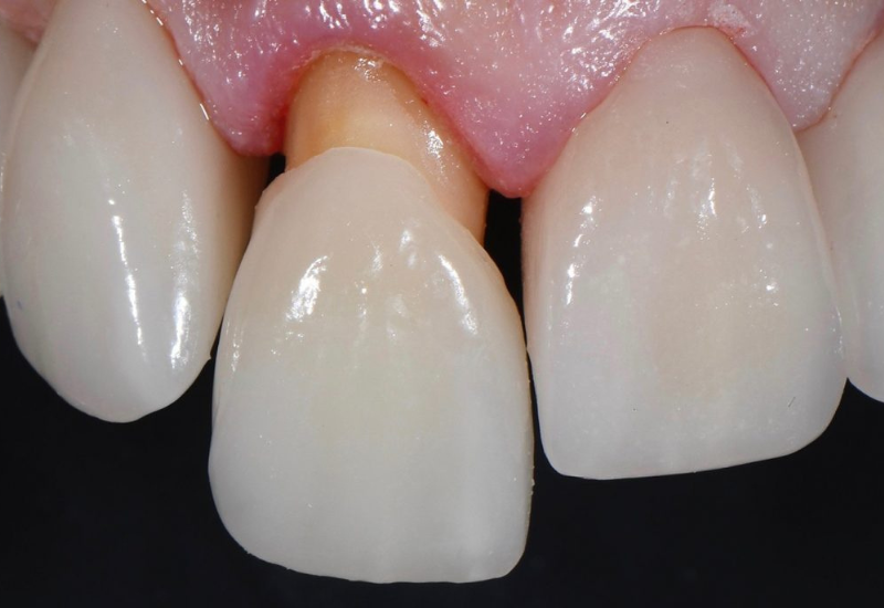 Việc nhận biết sớm các dấu hiệu răng sứ bị hở sẽ giúp bạn kịp thời khắc phục tình trạng này