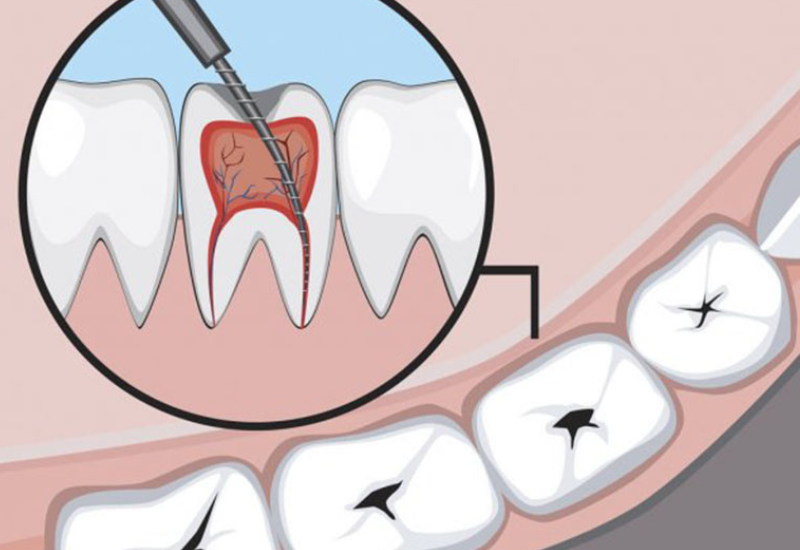 Việc lấy tủy trước khi bọc răng sứ được đưa ra dựa trên tình trạng cụ thể của từng bệnh nhân và quyết định của bác sĩ