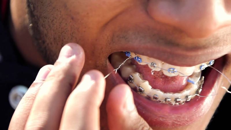 Niềng răng thất bại có thể dẫn đến nhiều vấn đề về răng miệng