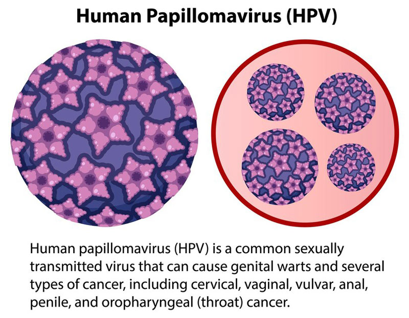 HPV là tác nhân gây bệnh sùi mào gà