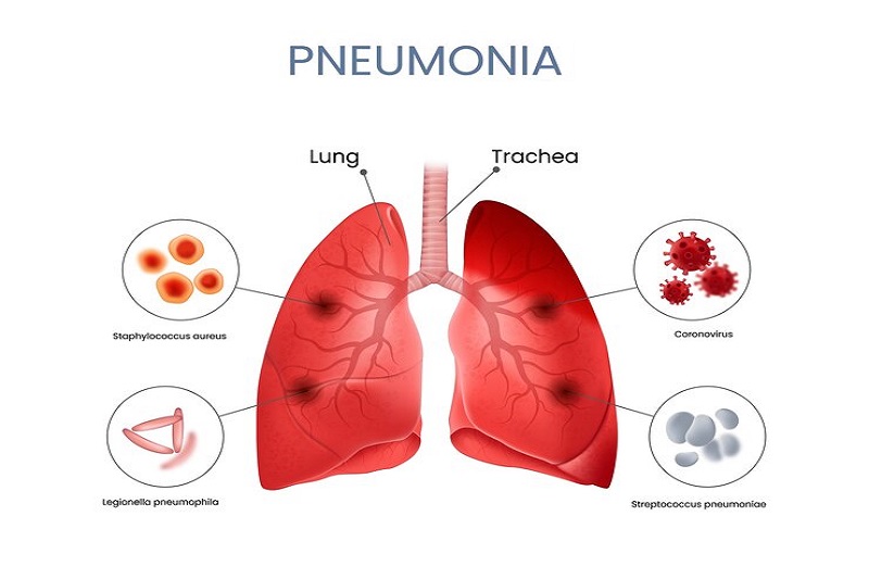 Viêm phổi làm tăng nguy cơ phù phổi