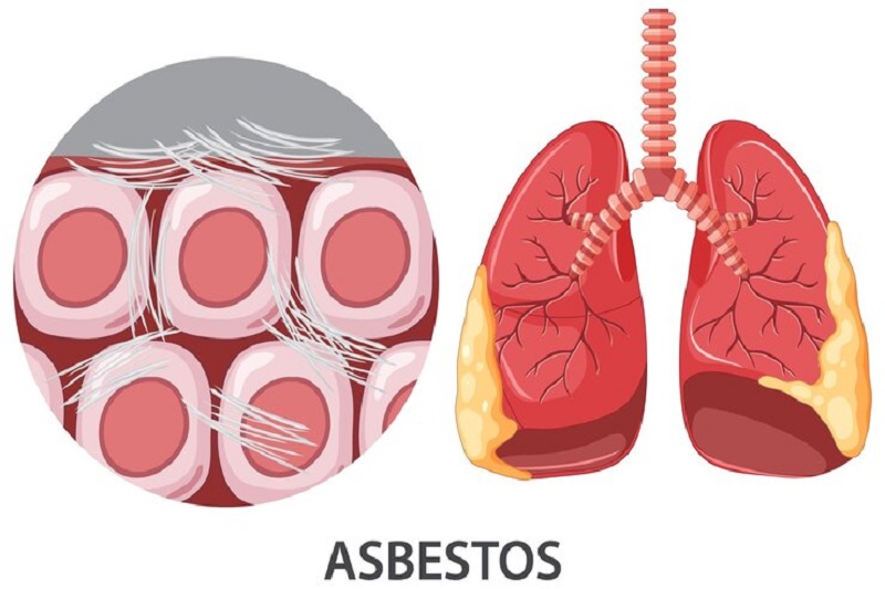 Tiếp xúc với bụi amiăng trong thời gian dài là một trong các nguyên nhân gây xơ phổi