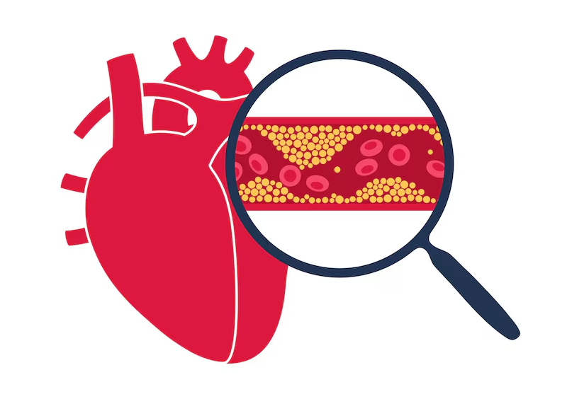 Sự tích tụ chất béo và mảng bám cholesterol là một phần gây nên bệnh tim thiếu máu cục bộ mạn tính