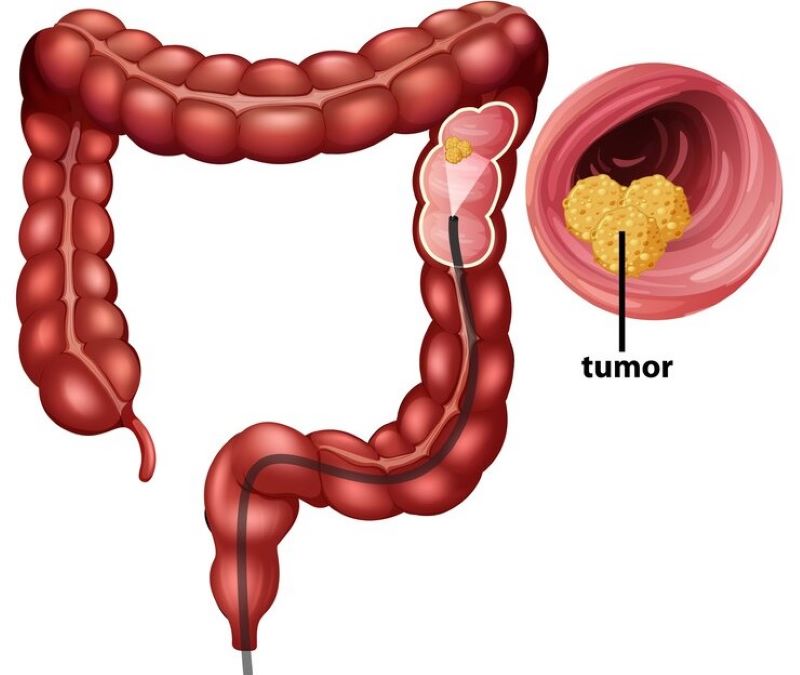 Sự tăng sinh bất thường tế bào niêm mạc đại tràng có thể hình thành u ác tính