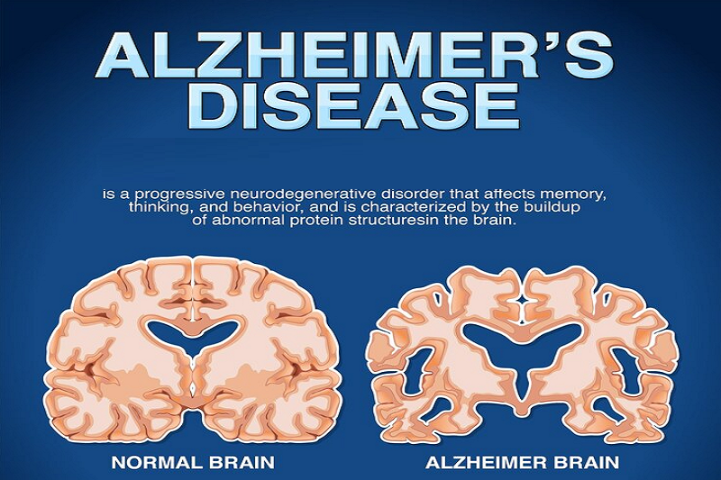 Bệnh Alzheimer là nguyên nhân gây giảm sút và mất dần trí nhớ