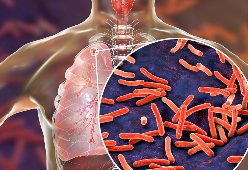 Vi khuẩn lao dễ dàng lây nhiễm qua đường hô hấp