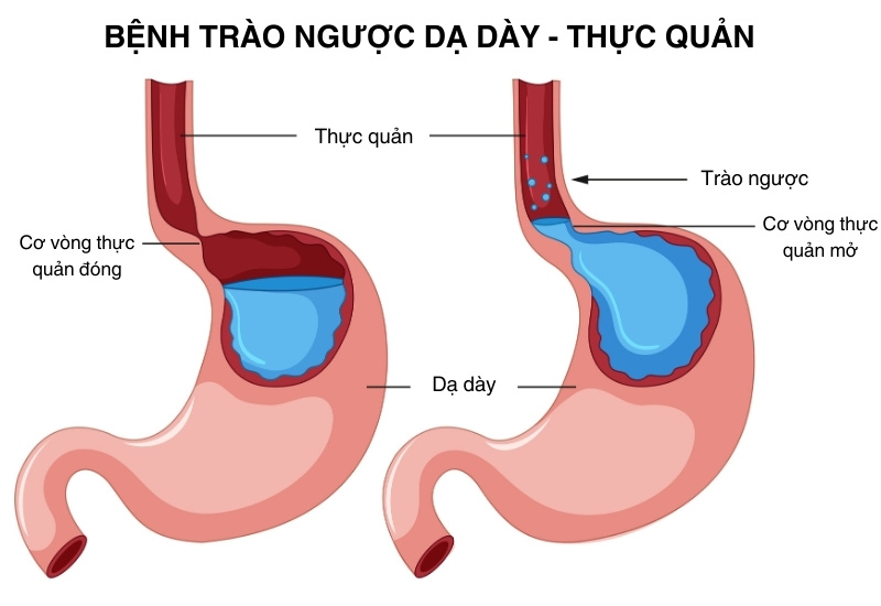 Bệnh <a href='https://medlatec.vn/tin-tuc/trao-nguoc-da-day-trieu-chung-nguyen-nhan-va-cach-dieu-tri-s195-n17818'  title ='trào ngược dạ dày'>trào ngược dạ dày</a> thực quản