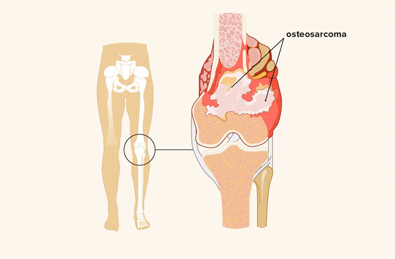 Tiến trình phục hồi và dự đoán kết quả điều trị ung thư xương khớp?
