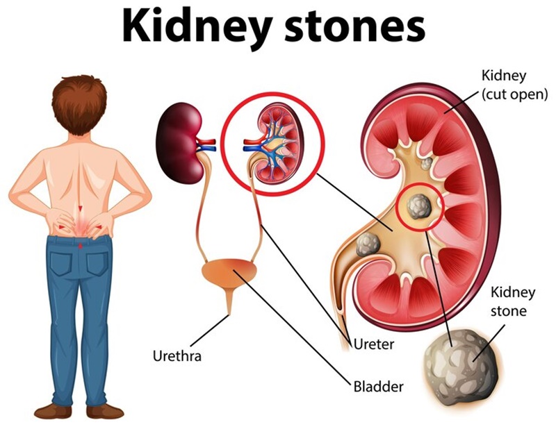 Sỏi thận có thể là nguyên nhân gây suy thận