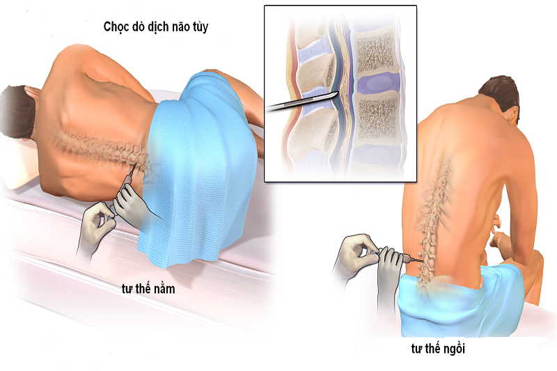 Mô phỏng lấy dịch tủy trong thủ thuật chọc dịch não tủy