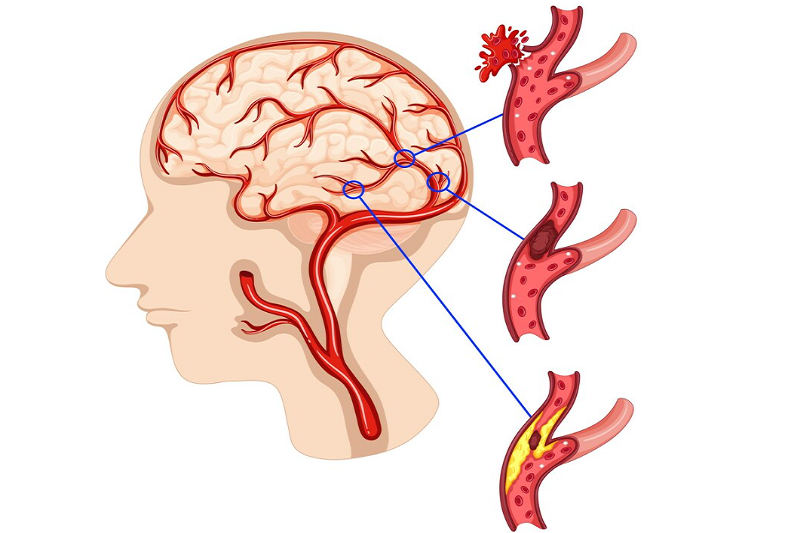 Mô phỏng về sự hình thành cơn nhồi máu não