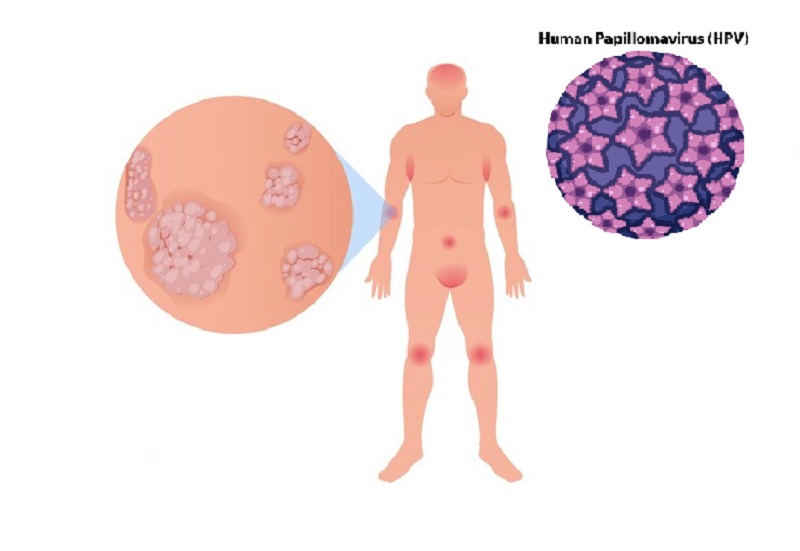 Virus Human Papillomavirus là tác nhân gây nên bệnh sùi mào gà hậu môn