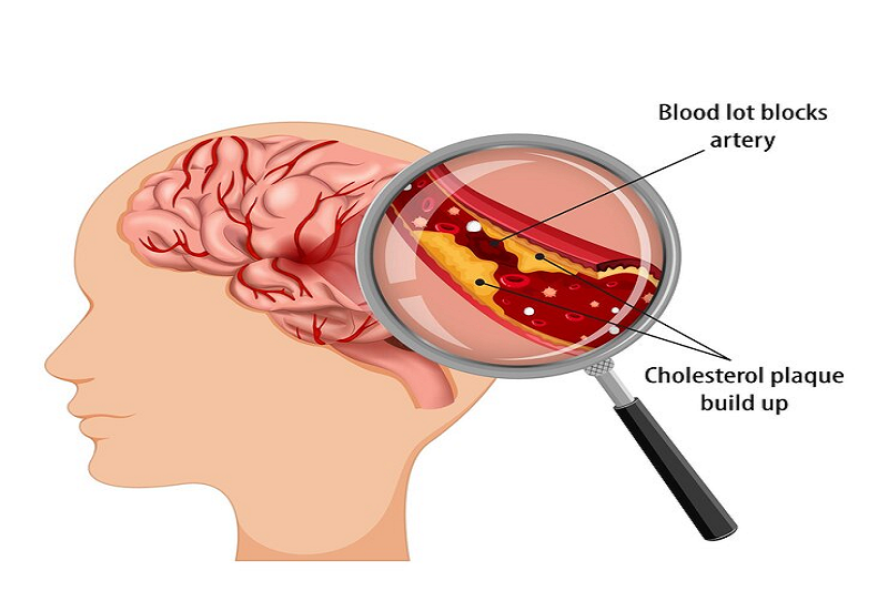 Đột quỵ có thể trở thành nguyên nhân gây thoái hóa tiểu não