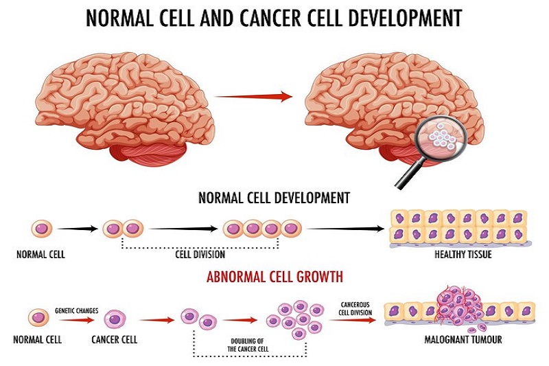 Mô phỏng về sự nhân lên bất thường của tế bào ung thư não