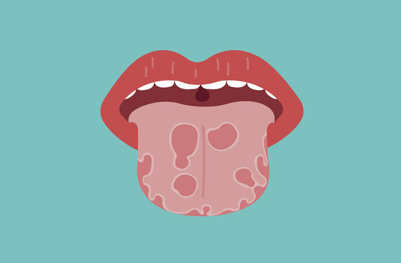 Các yếu tố nguyên nhân gây ung thư lưỡi là gì? 
