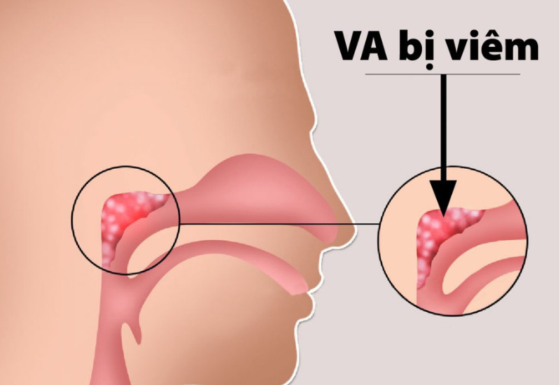  Virus gây cảm lạnh là nguyên nhân chủ yếu của bệnh viêm VA ở trẻ.