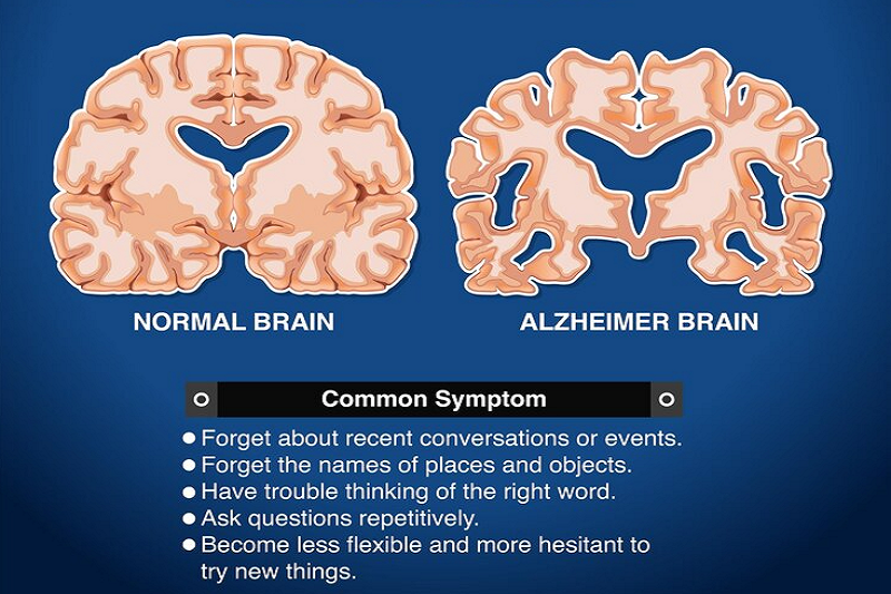 Người mắc bệnh Alzheimer gặp vấn đề về trí nhớ, thay đổi bất thường về hành vi