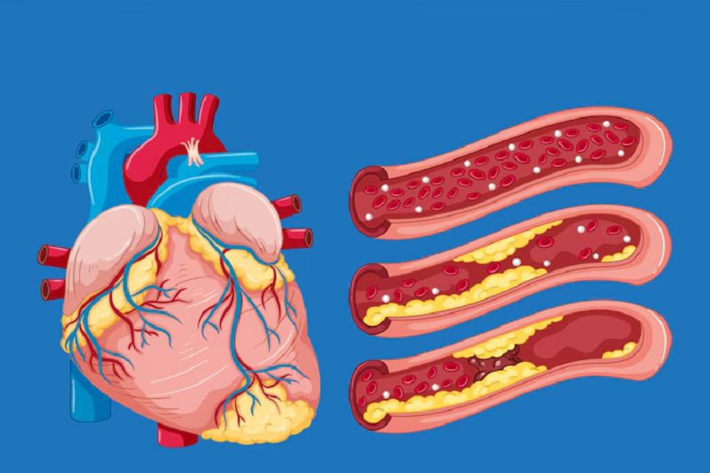 Xơ vữa động mạch có thể gây nên tình trạng chuột rút bắp chân