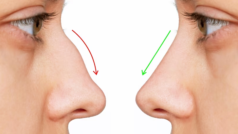 Sự khác biệt giữa mũi hếch và mũi bình thường