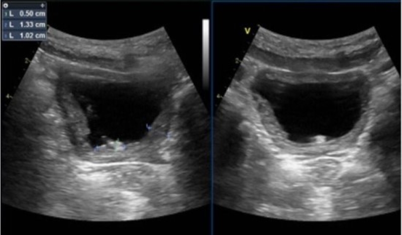 Hình ảnh siêu âm phát hiện thành bàng quang dày 10.2mm, trong có đám sỏi kích thước 13x5mm