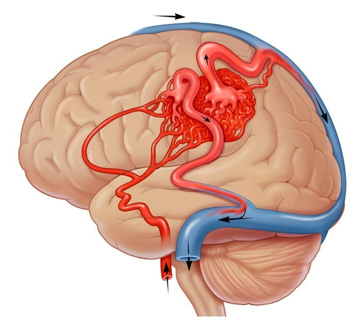 Dị dạng mạch máu não