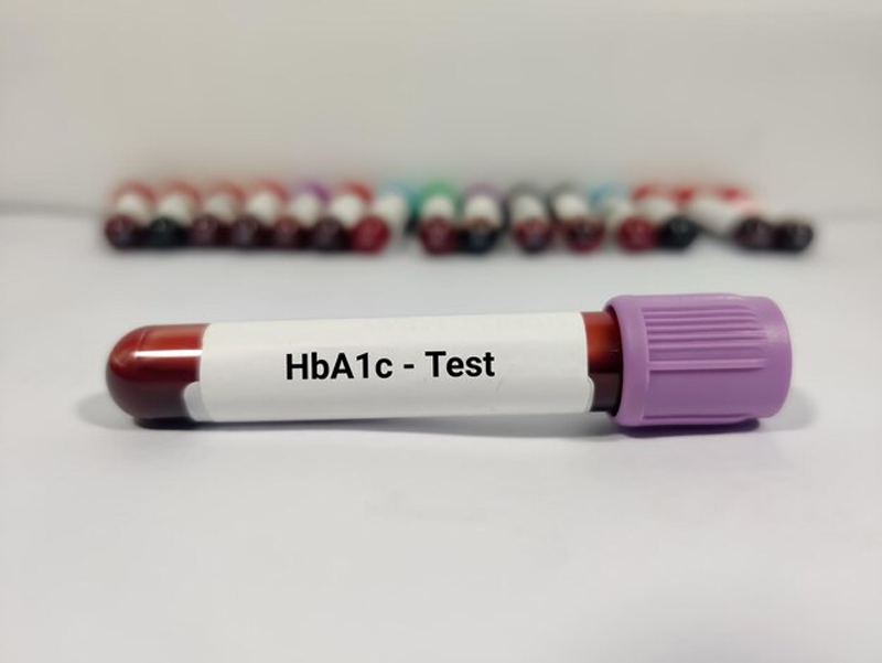 Xét nghiệm HbA1c để tầm soát hoặc theo dõi bệnh lý tiểu đường