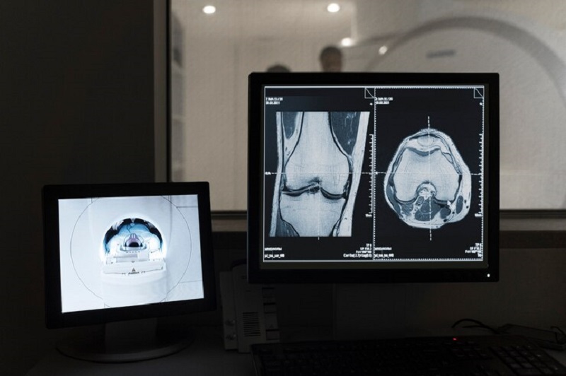 Chụp CT-Scanner giúp bác sĩ có căn cứ chẩn đoán chấn thương dây chằng đầu gối