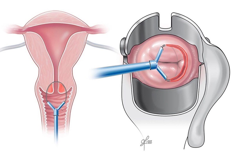 Phẫu thuật khoét chóp cổ tử cung cần được thực hiện để ngăn chặn ung thư cổ tử cung tiến triển