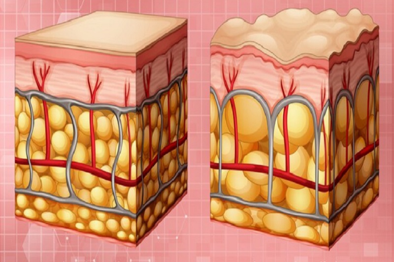 Hình ảnh mang tính chất minh họa về sự phì đại tuyến bã nhờn gây nên hạt Fordyce