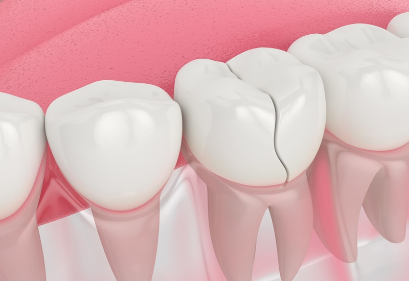Những nguyên nhân gây gãy chân răng và cách phòng ngừa