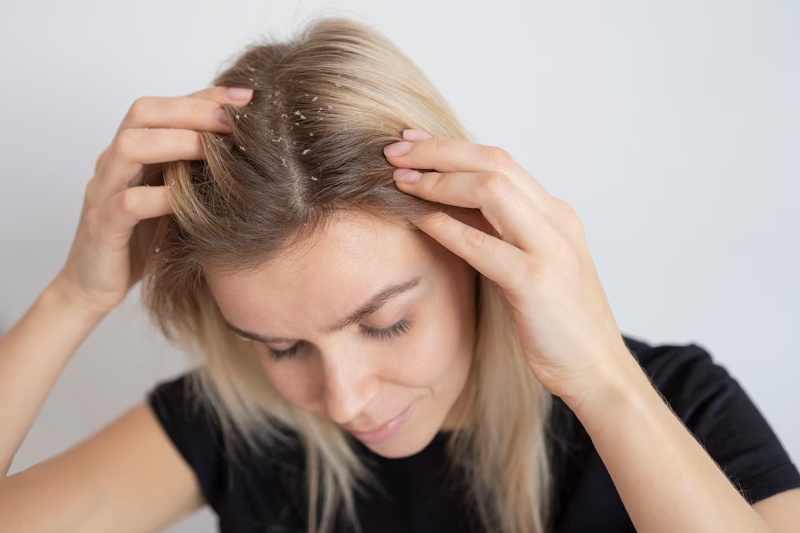 Không tắm gội, mắc bệnh lý da đầu cũng là nguyên nhân khiến tóc rụng nhiều sau sinh