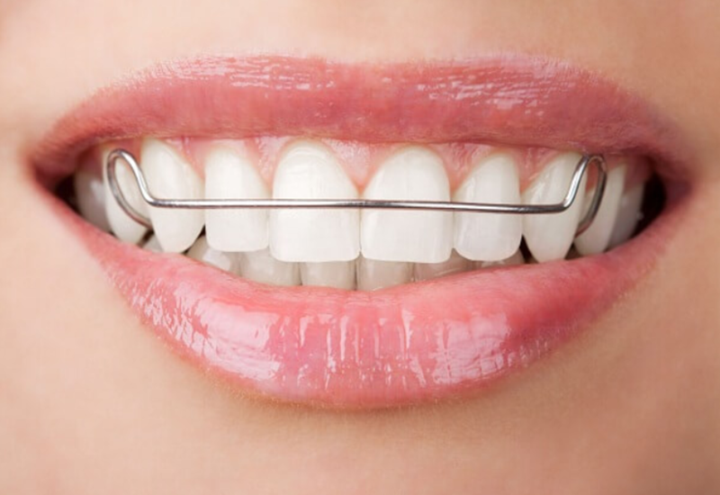 Tại sao niềng răng duy trì là quan trọng cho sự hoàn thiện nha cửu?