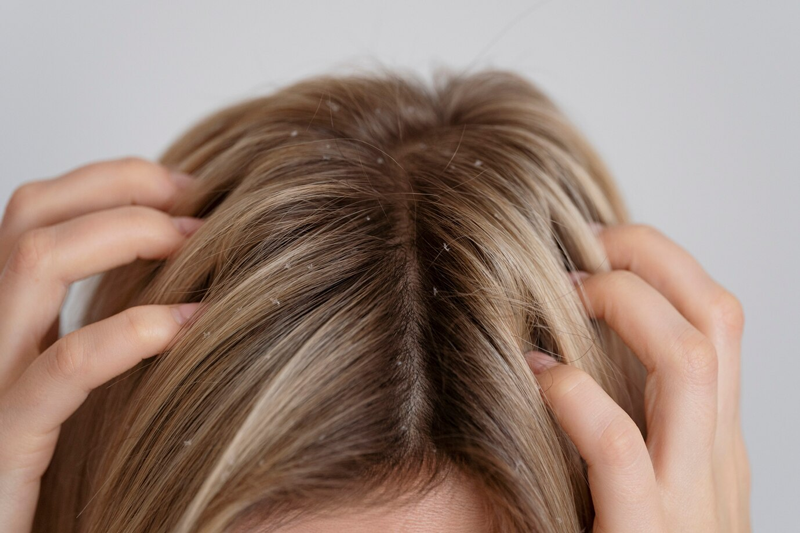 Các bệnh lý về da đầu có thể gây ra tình trạng gàu từng mảng 