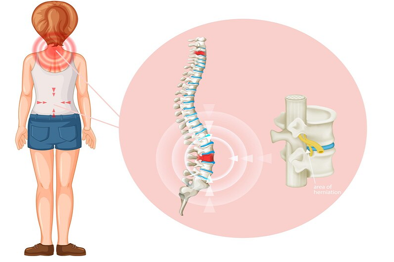 Hình ảnh mô phỏng bệnh thoát vị đĩa đệm cột sống thắt lưng