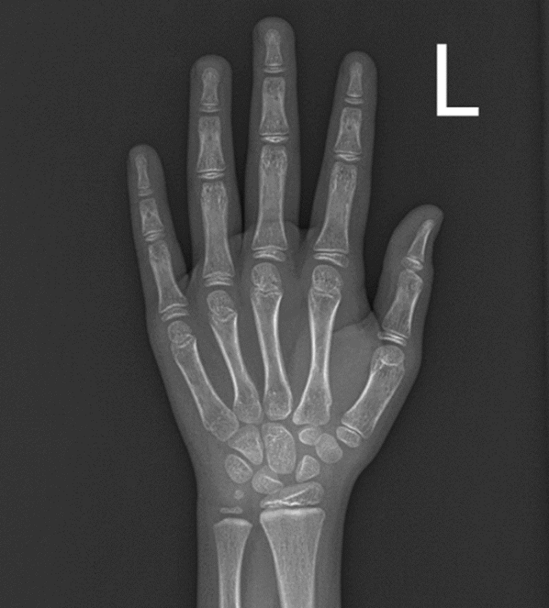 Kết quả chụp X-quang tay của bé L., có tuổi xương tương đương 8 tuổi