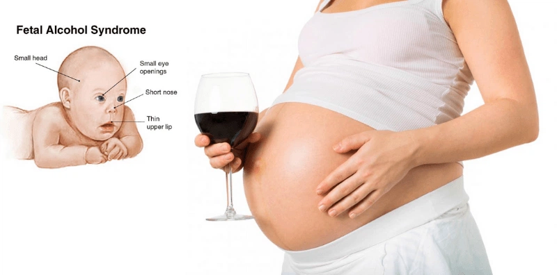 Trẻ có nguy cơ mắc hội chứng rượu bào thai nếu mẹ bầu uống bia rượu khi mang thai 