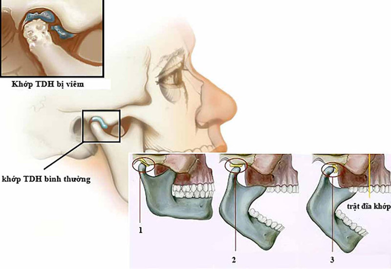 Viêm hay rối loạn khớp thái dương hàm có thể gây  đau đầu 2 bên thái dương